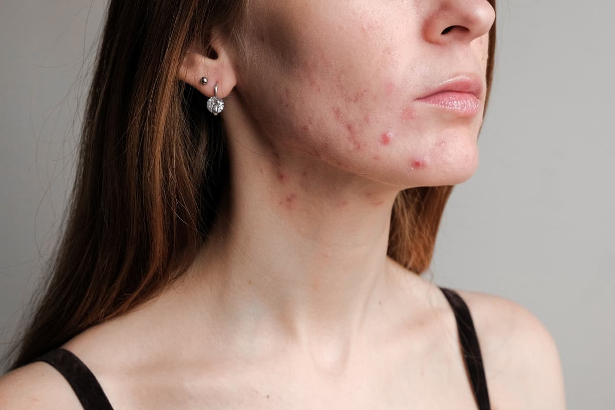 woman with bad skin and acne